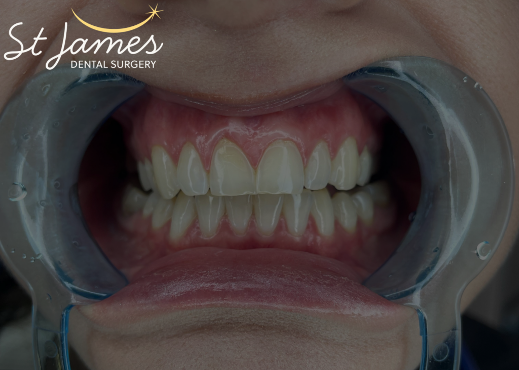 remove stains from teeth - hygiene or teeth whitening