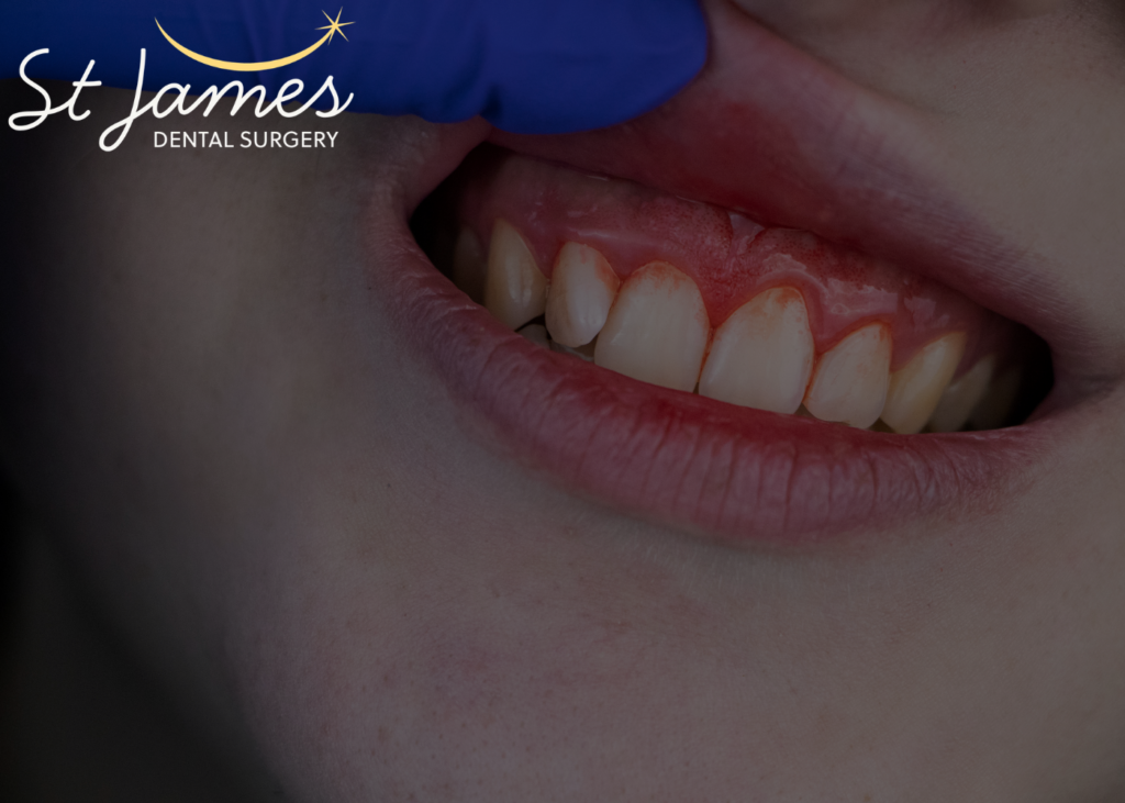 gingivitis symptoms - gums