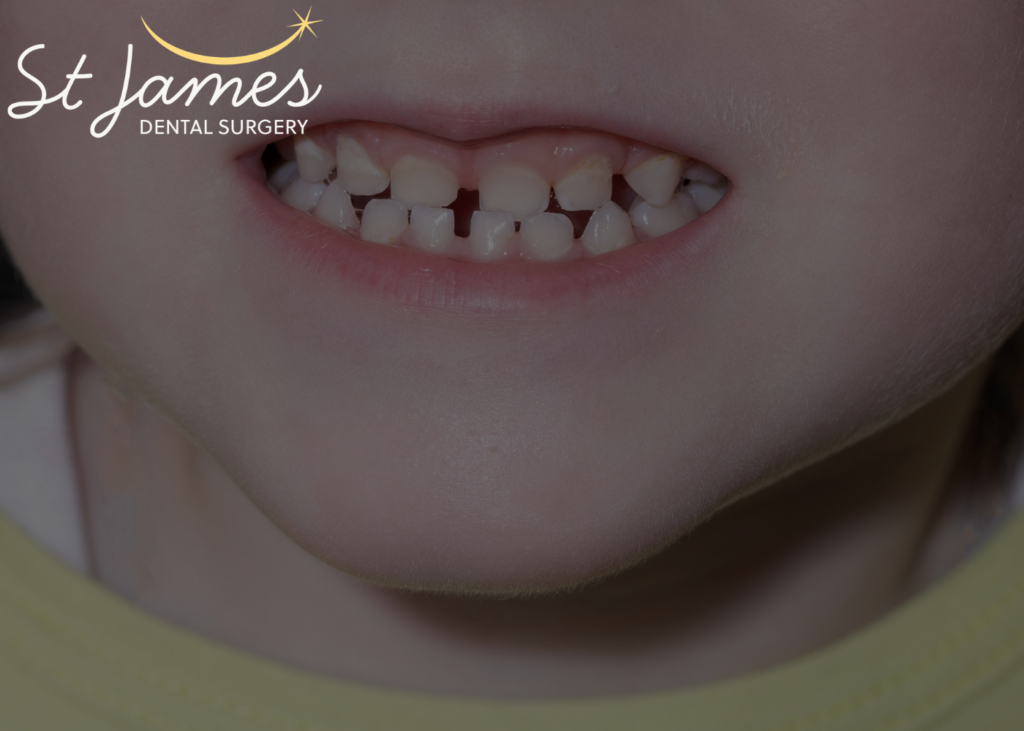 hypodontia - undeveloped teeth