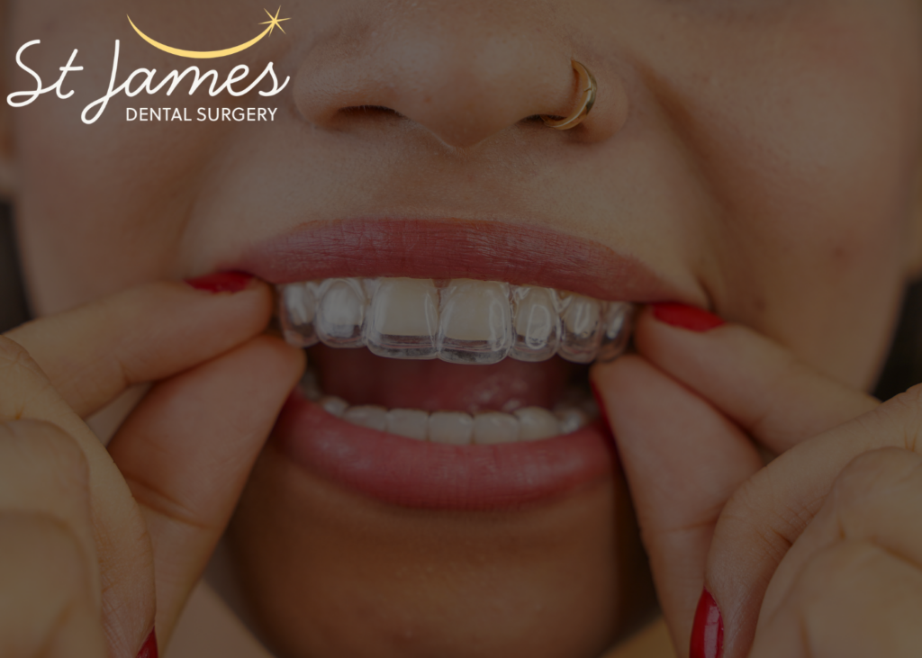 overbite teeth - Invisalign Muswell Hill